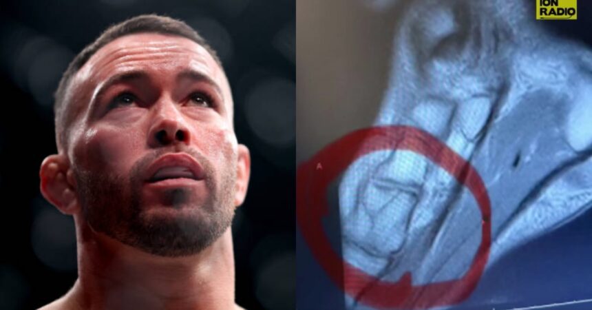 Colby Covington Releases X Rays Of Broken Leg Suffered In Loss